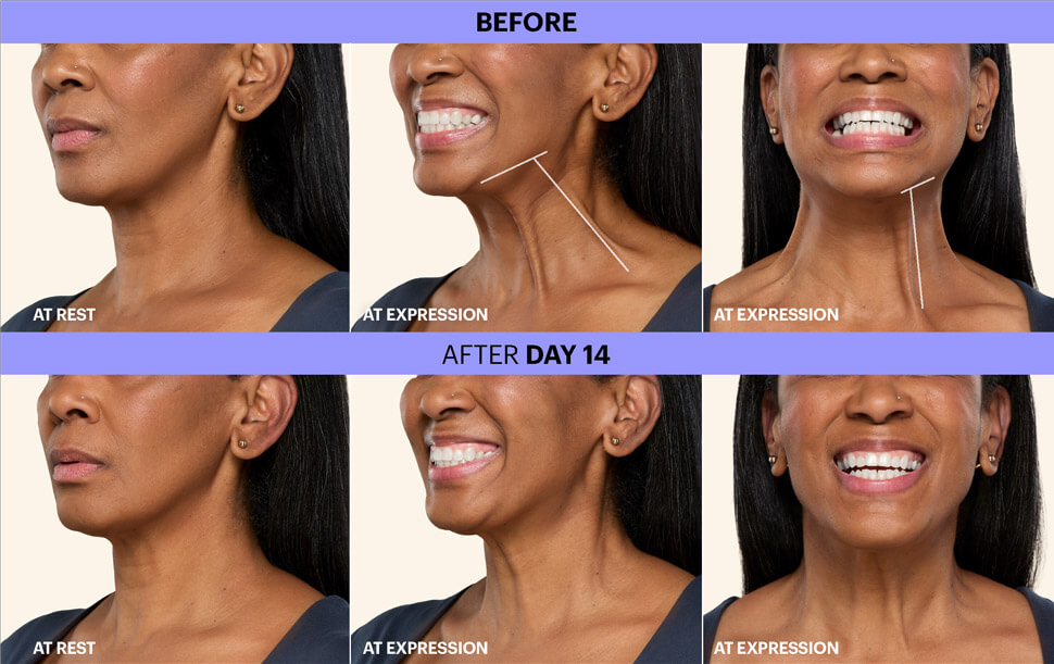 Botox Before and After